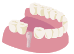 インプラント治療とは
