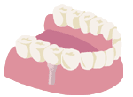 インプラント治療とは